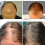 Hair loss treatment before and after images