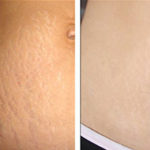 Before and after image of Improved skin texture with Platelet Rich Plasma (PRP) treatment
